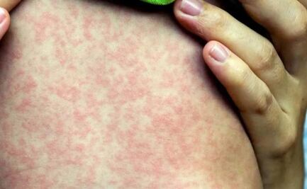 Yucatán confirma 10 casos de sarampión; ocupa en lugar 28 en tabla nacional de contagios