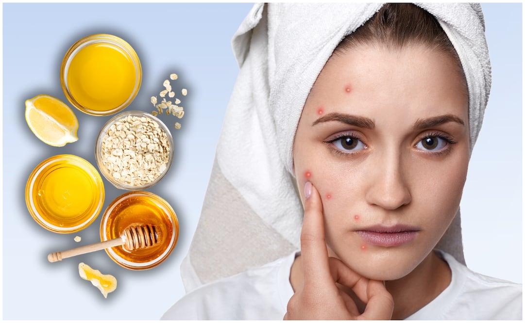Los mejores remedios caseros para eliminar las marcas de acné. Foto: Canva