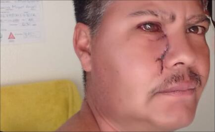 Árbitro casi pierde el ojo por agresión de un futbolista