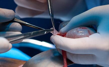 Logran que riñón de cerdo modificado funcione un mes en un cuerpo humano, un hito