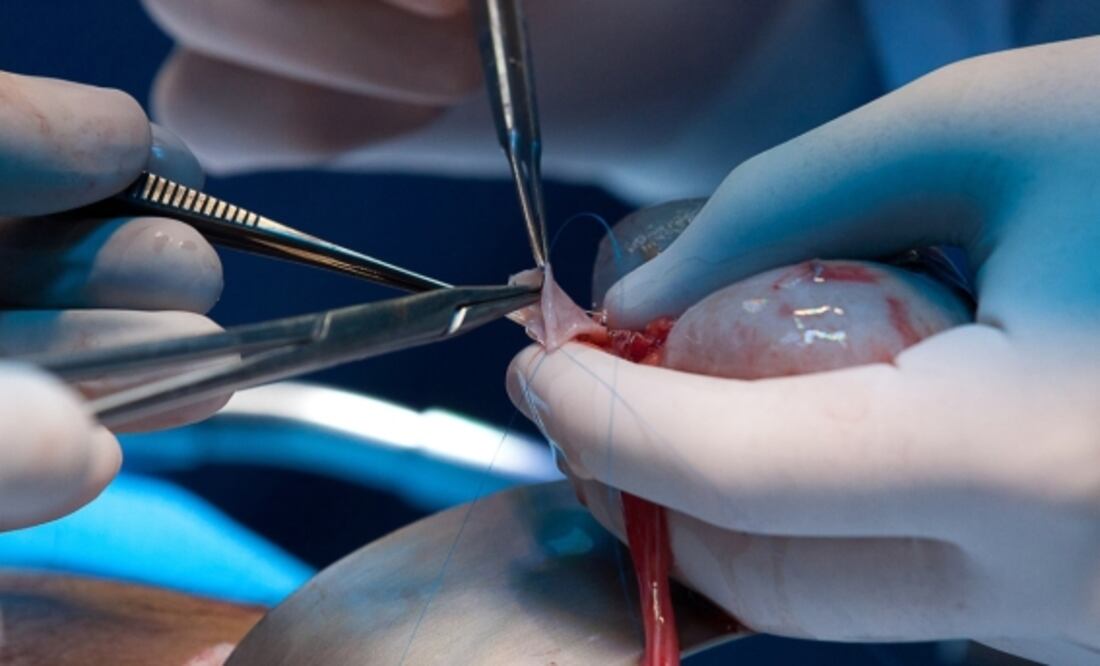 En otros transplantes de órganos de cerdos modificados se incorporaban hasta 10 modificaciones genéticas, pero en este estudio se usó un riñón con solo un gen modificado específicamente y ha funcionado por un mes.