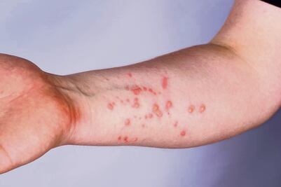 Descubren el mecanismo que ayuda a que la viruela del mono burle a la defensa del sistema inmunitario 