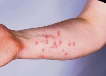 Descubren el mecanismo que ayuda a que la viruela del mono burle a la defensa del sistema inmunitario