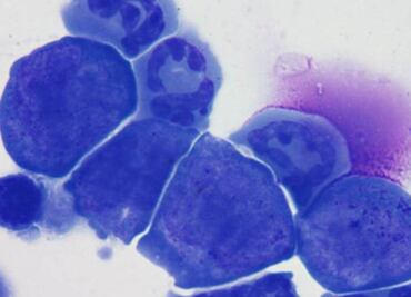 Prueban con éxito compuesto contra cáncer de colon y melanoma