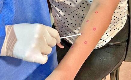 Detectan cuatro nuevos casos de mpox en Baja California Sur