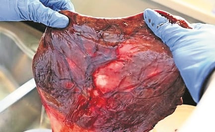 Proteínas en la placenta protegerían a bebés del Covid-19