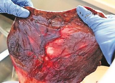 Proteínas en la placenta protegerían a bebés del Covid-19