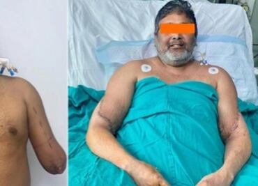 Artista perdió sus brazos en un accidente; un "ángel" le dio los suyos