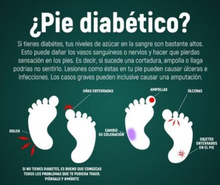 Pie diabético, primera causa de amputación