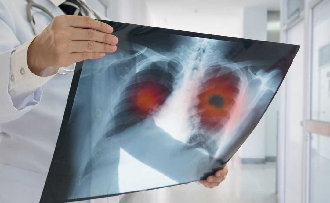 ilustración de una radiografía de unos pulmones. Foto: El Universal, archivo 