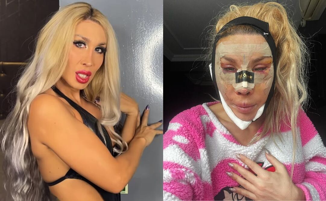 Pelopony acaba de someterse a seis cirugías hace unos días.
Fotos: Instagram