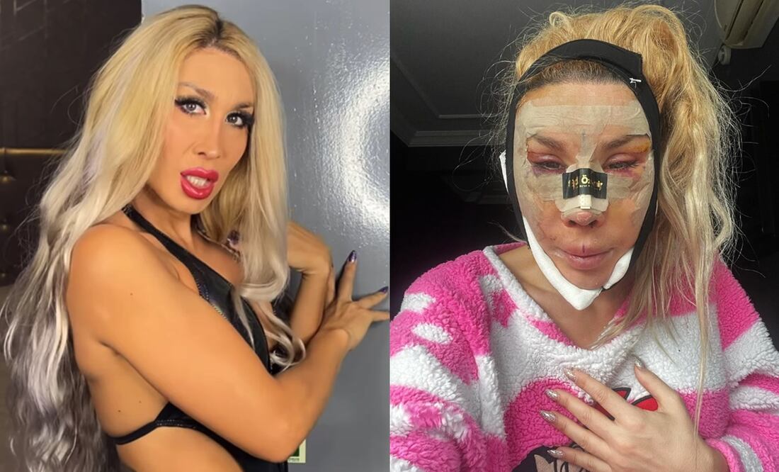 Pelopony acaba de someterse a seis cirugías hace unos días.
Fotos: Instagram