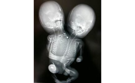 Interrumpen gestación de bebé con dos cabezas en Oaxaca 