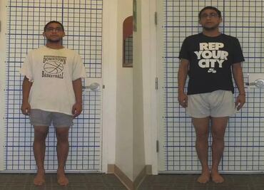 Hombres se someten a radical cirugía para verse más altos; les deben romper los huesos