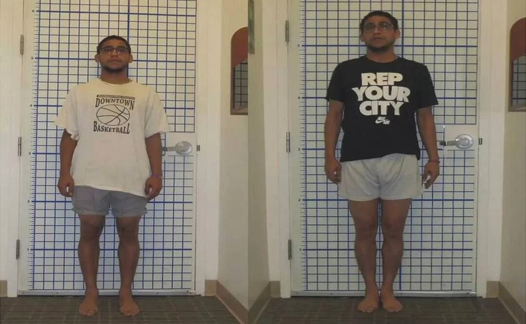 Sam se sometió a una operación que le ayudó a ganar unos centímetros. Foto: DR S. ROBERT ROZBRUCH