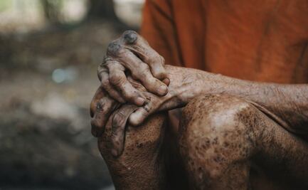 La lepra no llegó de Europa... ¡ya estaba aquí!