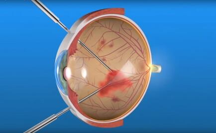 ¿Cómo se repara el desprendimiento de retina? 