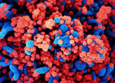 Déficit de una proteína sería la culpable de un Covid-19 grave