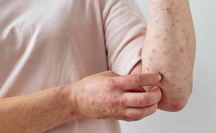 México registra 504 contagios de viruela del mono; CDMX, la entidad con más casos