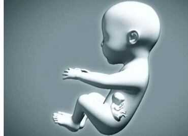 Nace bebé "embarazada" de su hermano gemelo en Colombia