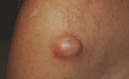 ¿Qué es un lipoma en la piel y cómo se cura?