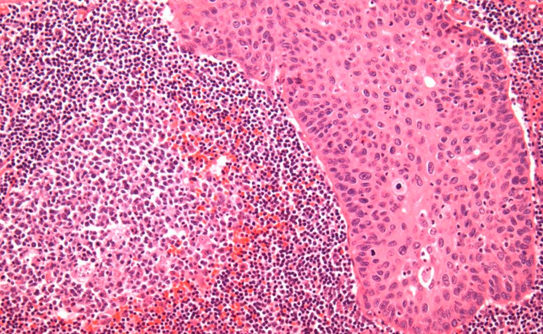 Foto: NewYork-Presbyterian/Columbia University Irving Medical Center, archivo