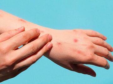 Confirman quinto caso de viruela del mono en Oaxaca