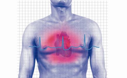 Hallan nuevas características genéticas asociadas al infarto de miocardio