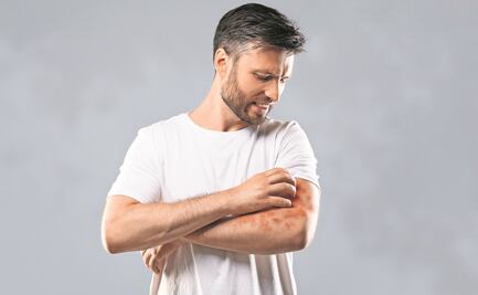 Psoriasis: tortura en la piel