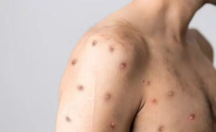 Europa registra casi 17 mil casos de viruela del mono