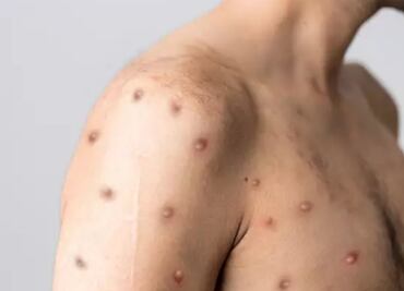 Europa registra casi 17 mil casos de viruela del mono