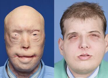 En NY, el trasplante de cara más complejo hasta hoy