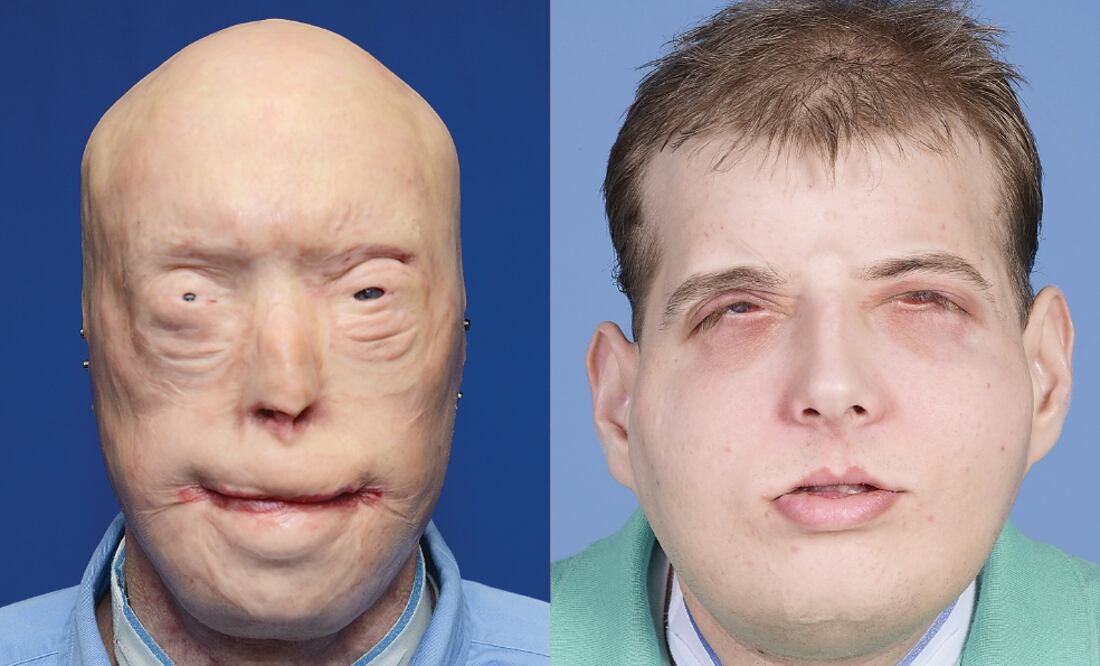 Patrick Hardison sufrió quemaduras de tercer grado hace 14 años al cumplir como bombero (NYU LANGONE MEDICAL CENTER)