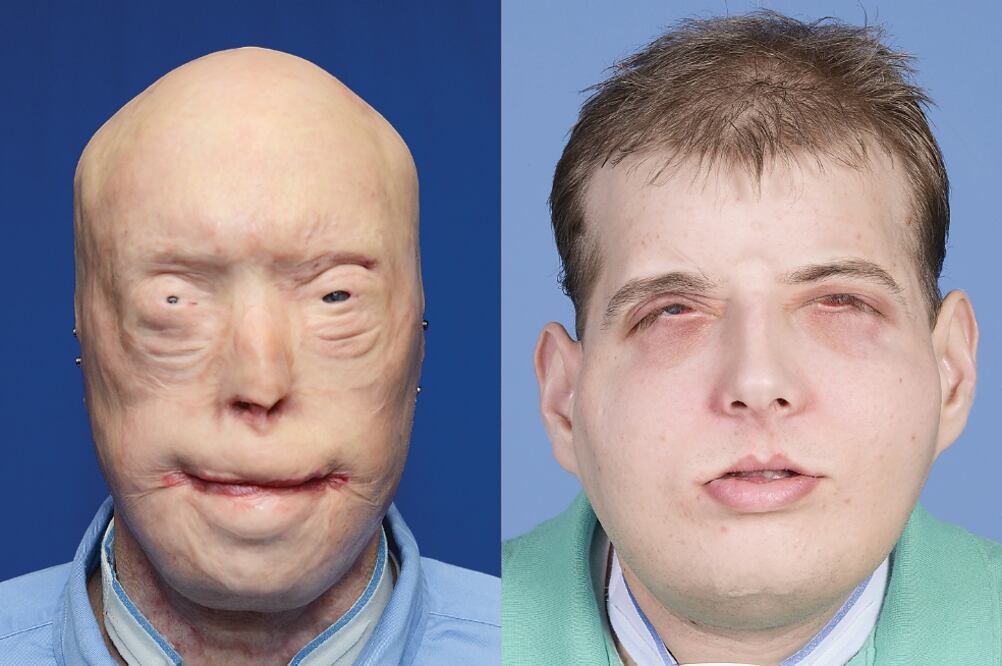 Patrick Hardison sufrió quemaduras de tercer grado hace 14 años al cumplir como bombero (NYU LANGONE MEDICAL CENTER)