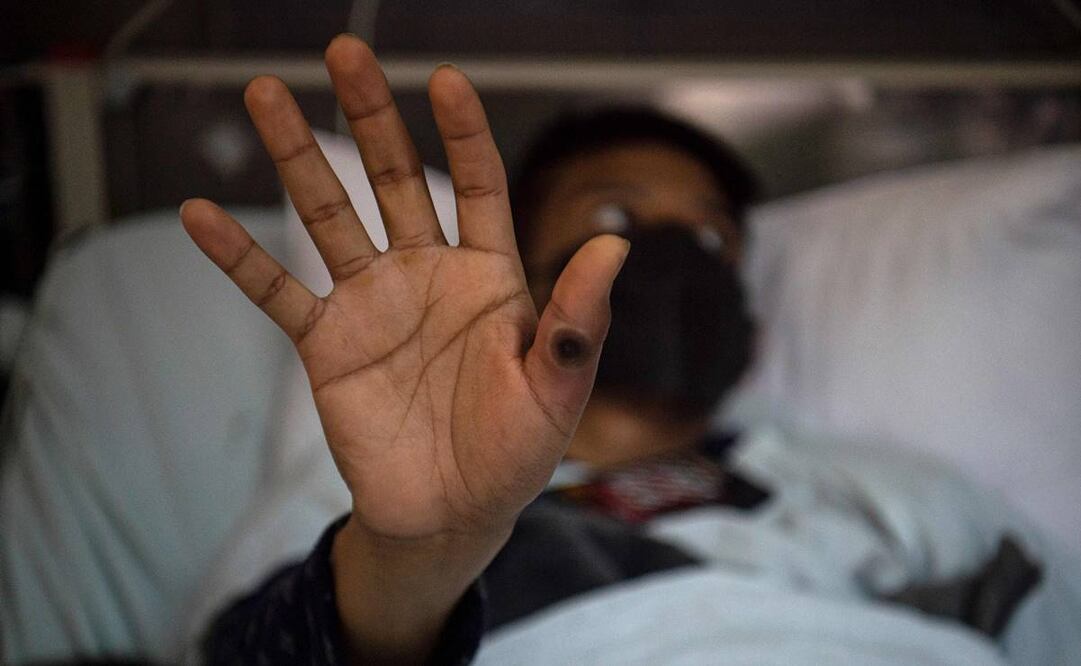 Mpox ha estado afectando a personas de África oriental durante más de una década. Foto: AFP