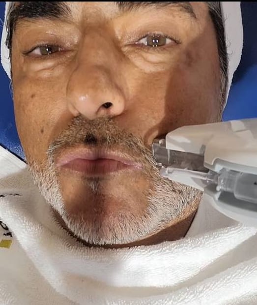 Raúl Araiza se somete a procedimiento estético en el rostro y lo presume en redes