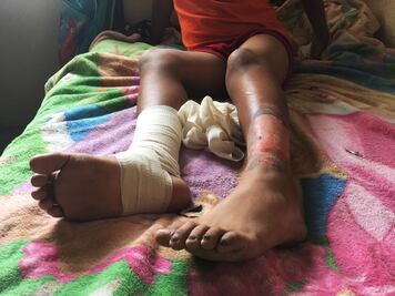 Niño sufre quemaduras por falla geotérmica en Michoacán