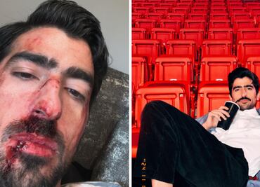 Influencer Jezzini sorprende al aparecer con rostro golpeado en Instagram; ¿qué le pasó?