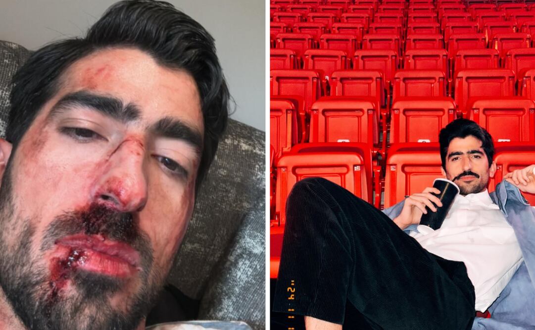 El creador de contenido desata especulaciones en redes sociales al mostrarse golpeado.
Foto: Caotura de pantalla en Instagram