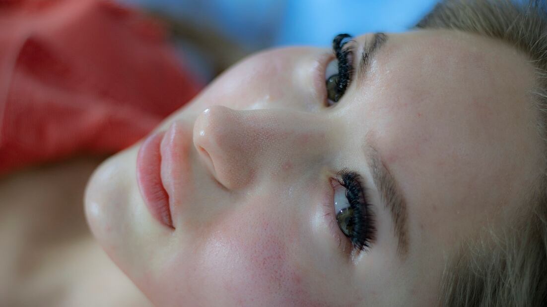 Acné. Fuente: Pixabay