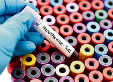 Día Mundial contra la Hepatitis: ¿qué es y por qué se conmemora cada 28 de julio?; conoce sus síntomas