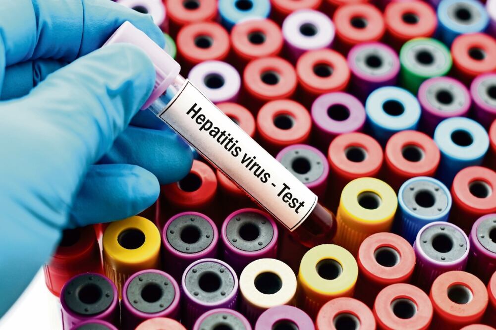 Tipos curables. Si la hepatitis en sus tipos A, B, C, D o E es diagnosticada y tratada a tiempo puede curarse en 98% de los casos. (ARCHIVO EL UNIVERSAL)