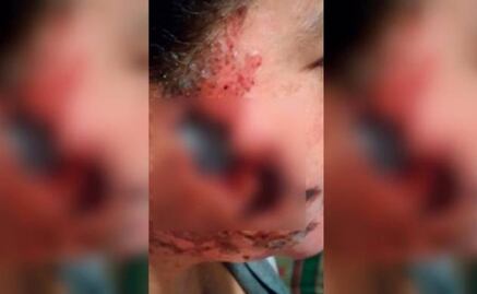 Arroja ácido al rostro de su ex por terminarlo