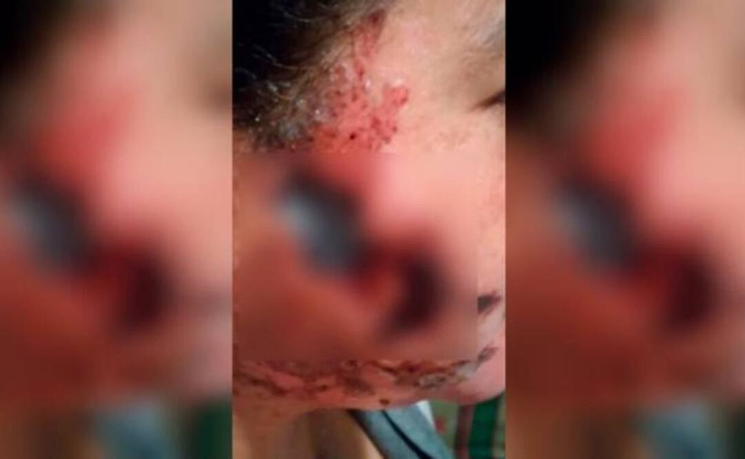 Arroja ácido al rostro de su ex por terminarlo