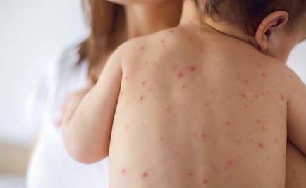 Sarampión: 8 mitos sobre las vacunas
