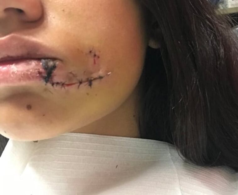 El peor final. Se sacaba fotos con un perro, le mordió la cara y le hicieron 40 puntos