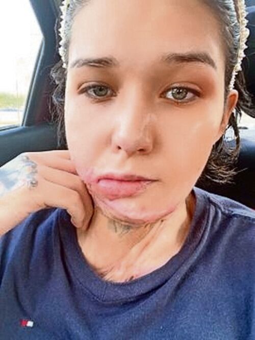 Liliana Fernández, de 24 años, madre de cuatro hijos, sufre dolor sicológico, emocional y físico tras casi una decena de cirugías.