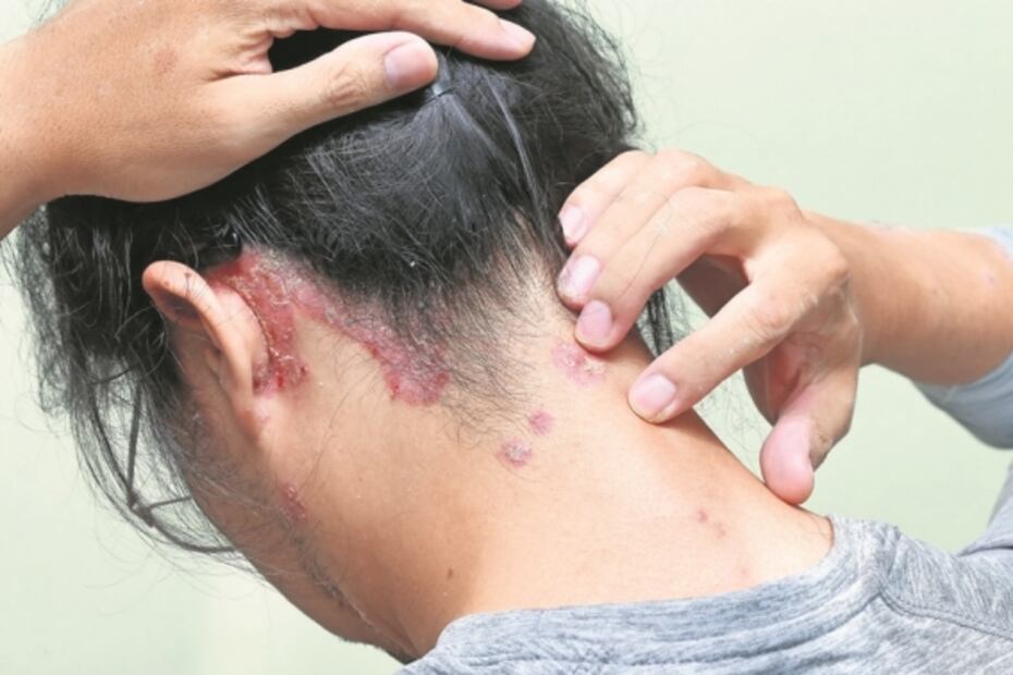 Psoriasis: tortura en la piel