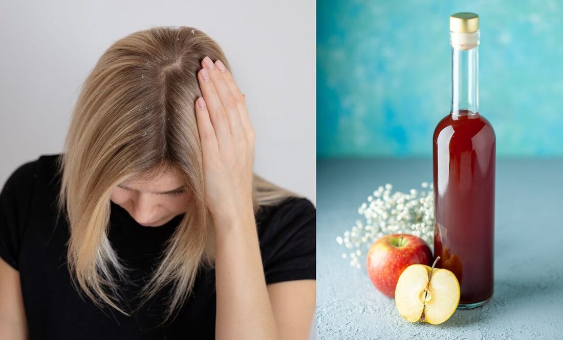 Si tienes caspa no te preocupes porque el vinagre de manzana puede resolverlo. Foto: Especial
