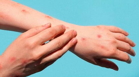 ¿Quién está protegido contra la viruela del mono?, experto lo esclarece